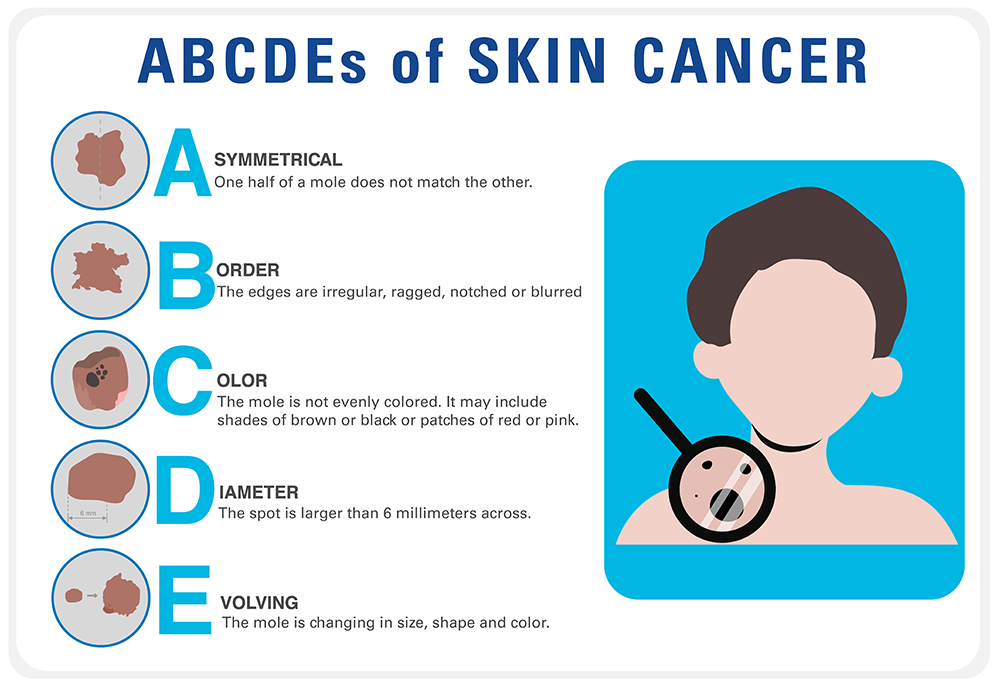 Skin cancer chart